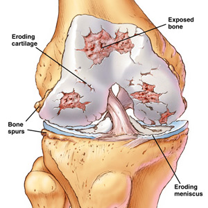 OsteoarthritisKnee1.jpg