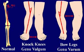 tibiofemoral_angle_2.jpg